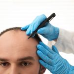 Greffe de cheveux en Turquie : une destination prisée pour retrouver sa densité capillaire