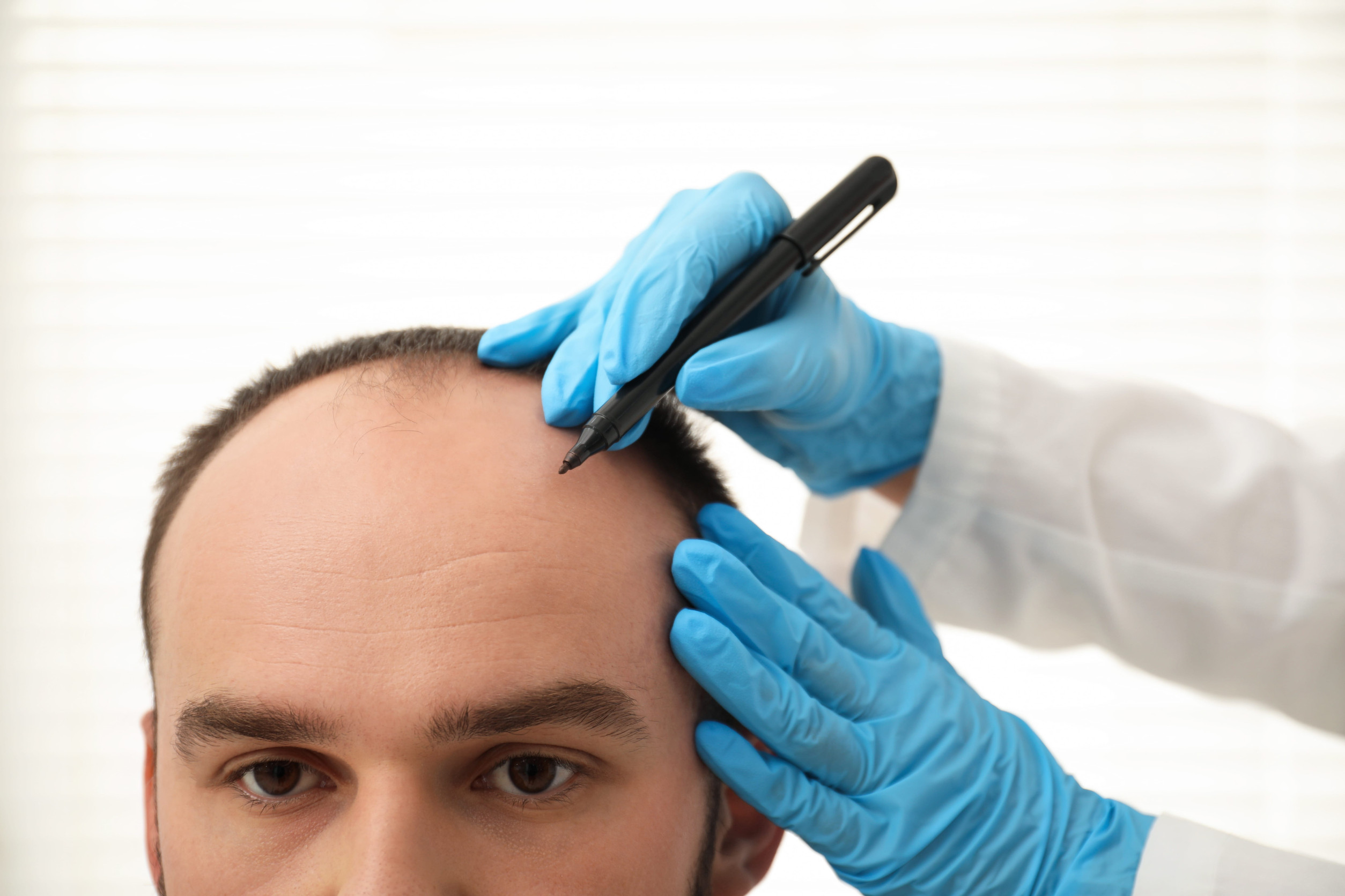 Greffe de cheveux en Turquie : une destination prisée pour retrouver sa densité capillaire