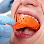 Les solutions durables pour remplacer une ou plusieurs dents